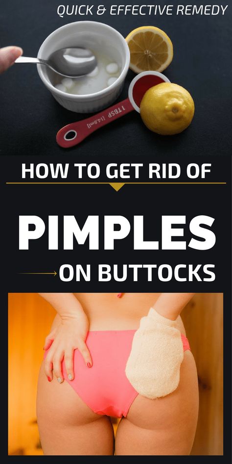 Buttocks Acne, Pimples On Buttocks, Chest Acne, Get Rid Of Pimples, Rid Of Pimples, Forehead Acne, Pimples Under The Skin, Acne Overnight, Pimples Remedies