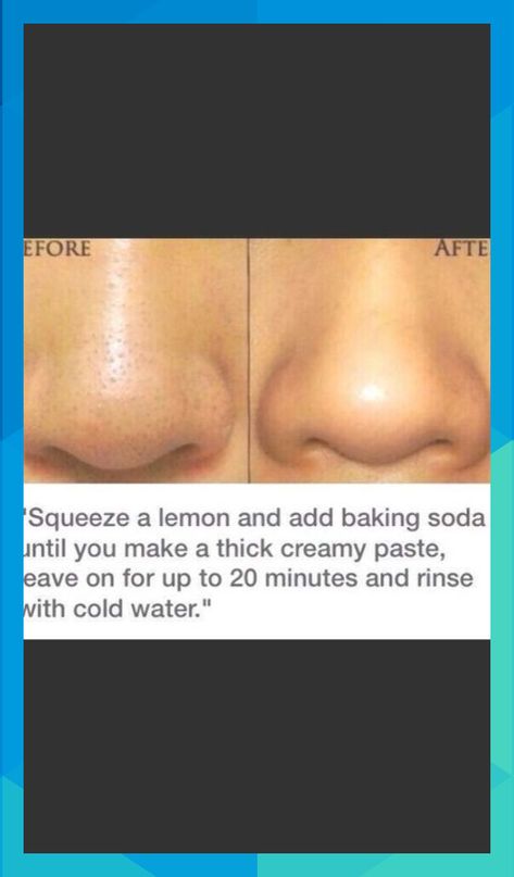 Homemade Acne Remedies, Exposed Skin Care, Black Heads, Natural Acne, Nail Care Tips, Homemade Beauty, Acne Remedies, Skin Pores, Skin Care Treatments