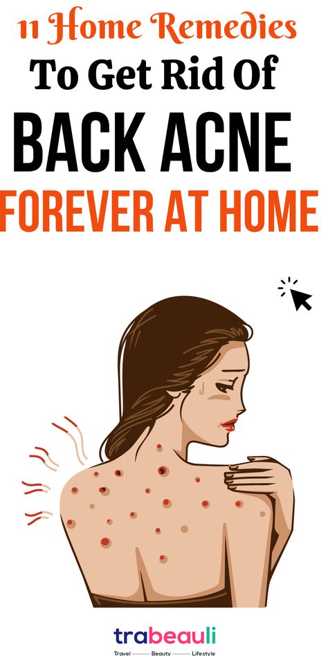 Home Remedies to Get Rid of Back Acne Acne On Back How To Get Rid, Get Rid Of Back Acne Fast, Back Exfoliation, Back Acne Remedies Diy, Clearing Back Acne, Chest And Back Acne Remedies, Backne Remedies, Remedies For Back Acne, Rid Of Back Acne