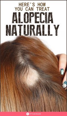 What Is Alopecia And How To Treat It Naturally: Watching clumps of hair fall out of your scalp can never be something you can take lightly. When it gets to the point where you can see bald spots appear on your scalp, it can induce real fear in your heart. Here are some of the best remedies you can try. #Hair #HairCare #Alopecia #Remedies #HomeRemedies #NaturalRemedies Desserts Potluck, Hair Fall Remedy Home, Hair Fall Remedy, Girly Tips, Handmade Socks, Home Remedies For Hair, Healthy Advice, Regrow Hair, Birthday Blessings