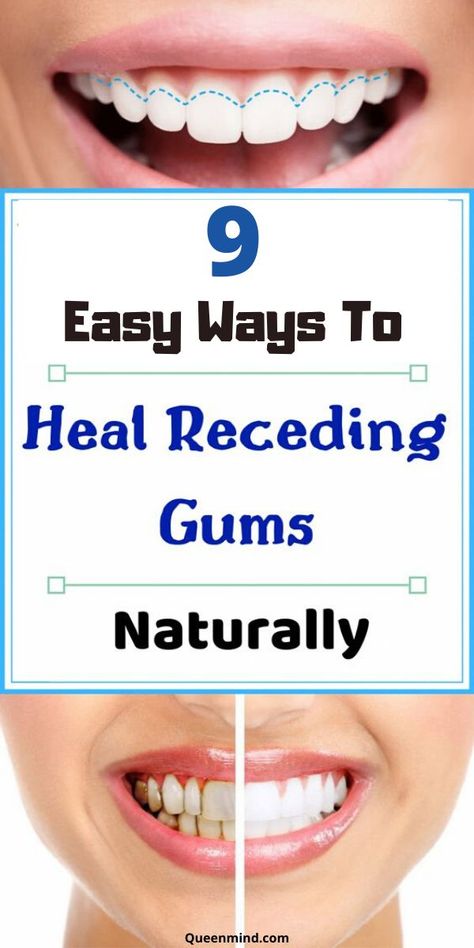 Reverse Receding Gums, Gum Recession, Dental Cavities, Oral Care Routine, Receding Gums, Gum Care, Dental Problems, Oral Health Care, Tooth Decay