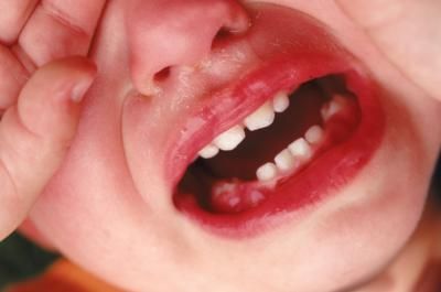 Problems from loosing Baby Teeth Swollen Gum, Loose Tooth, Baby Gums, Fever Reducer, White Patches, Mayo Clinic, Family Health, Baby Teeth, Tooth Decay