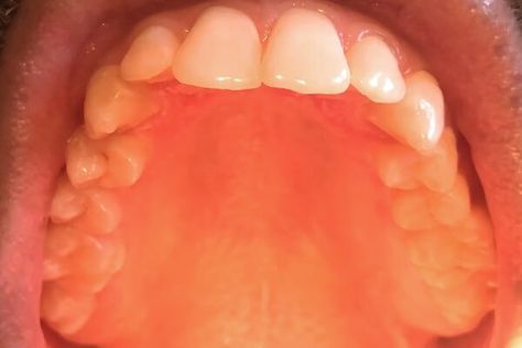 There are at least a dozen different things that can give you an itchy roof of mouth (palate). ... Roof Of Mouth Sore Remedy, Sores In Mouth, Sores In Mouth Remedies, Remedy For Mouth Ulcers, Roof Of Mouth Sore, Aloe Vera For Sunburn, Remedies For Dry Mouth, Home Remedies For Allergies, Home Remedies For Warts