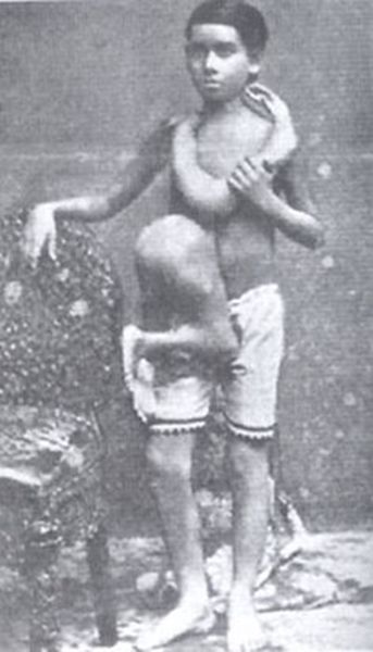 A rare image of young Laloo with parasitic twin (1874 - 1905) Human Oddities, Circus Sideshow, Side Show, Rare Images, Lion Face, Vintage Circus, Find A Grave, Weird Stuff, Special People