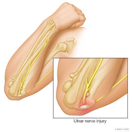 Overview Ulnar Nerve Exercises, Musculoskeletal Disorders, Cubital Tunnel Syndrome, Nerve Problems, Radial Nerve, Ulnar Nerve, Nerve Health, Muscle Atrophy, Strep Throat