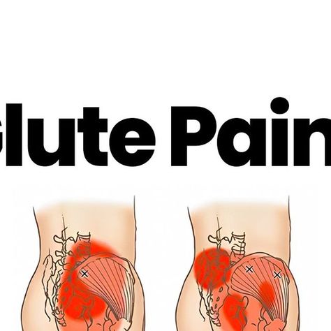 Recover Pain | Online Pain Clinic on Instagram: "⚡️GLUTE PAIN⚡️

Glute pain can arise when the muscles in the buttocks (piriformis, gluteus medius, maximus…), become tense, strained, or experience spasms. These muscles play a crucial role in our day-to-day movements, especially hip external rotation.

Symptoms may include pain in the buttocks, muscle tenderness, and sometimes radiating pain down your leg…

Strengthening and releasing your glute muscles can help reduce the symptoms and help you recover from pain.

⬆️ Here are 6 of my favorite exercises for releasing & strengthening the glutes and overcoming the pain.

1️⃣ Hip Airplane
2️⃣ Single Leg RDL
3️⃣ Single Leg Bridge
4️⃣ 90 / 90 Stretch
5️⃣ Side Lying Hip Abduction
6️⃣ (Banded) Good Mornings

Pick 3 of these exercises & perform 3 se Hip External Rotation, Single Leg Rdl, Hip Abduction, Glute Medius, Glute Muscles, Bursitis Hip, Piriformis Muscle, Hip Pain Relief, Piriformis Syndrome