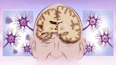 The 5 Stages of Alzheimer’s Disease Types Of Cancers, Hearing Loss, Power Of Positivity, Alzheimers, Brain Health, Warning Signs, Joy And Happiness, Health Benefits, Disease