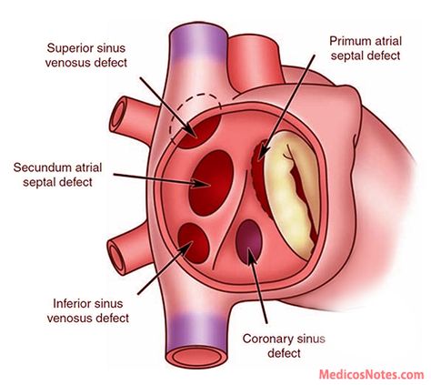 Cath Lab Nursing, Cardiac Anatomy, Cardiac Sonography, Atrial Septal Defect, Sonography Student, Diagnostic Medical Sonography, Ultrasound Technician, Congenital Heart Defect, Cardiac Nursing