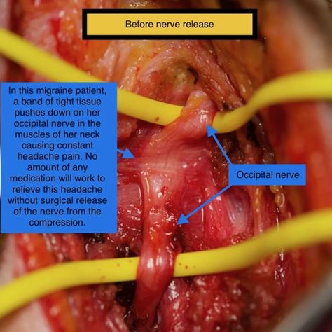 Occipital Nerve Decompression Photos | Migraine Surgery Specialty Center Occipital Neuralgia Relief, Sternocleidomastoid Muscle, Occipital Neuralgia, Constant Headaches, Neck Problems, Chiari Malformation, Neck Surgery, Surgical Tech, Severe Headache