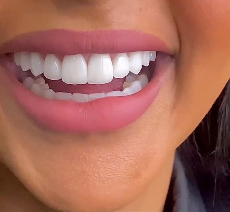 Nice Smile Teeth, Perfect Smile Teeth Women, Nice Teeth Smile, Big Front Teeth, Teeth Makeover, Perfect Smile Teeth, Teeth Aesthetic, Cosmetic Dentistry Procedures, Pretty Teeth