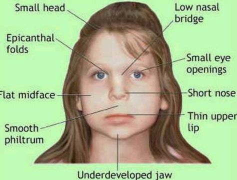 Living with Fetal Alcohol Syndrome is more than just living with these common features... they also suffer from emotional problems, hearing disorders, memory problems, motor skill issues, learning disabilities, and speech impediments for the rest of their lives. Living with it is like being forced to serve out a lifelong prison sentence for a crime your mother committed and you'll have no chance for parole... Epicanthic Fold, Prenatal Development, Fetal Alcohol Spectrum Disorder, Fetal Alcohol, Facial Anatomy, Ob Nursing, Genetic Disorders, Spectrum Disorder, Smooth Lips