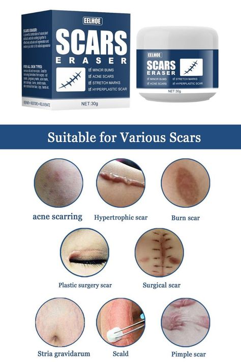 Hypertrophic Scars, Facial Scars, Scar Removal Cream, Pimple Scars, Scar Cream, Stretch Mark Cream, Stretch Mark Removal, Do's And Don'ts, Scar Removal