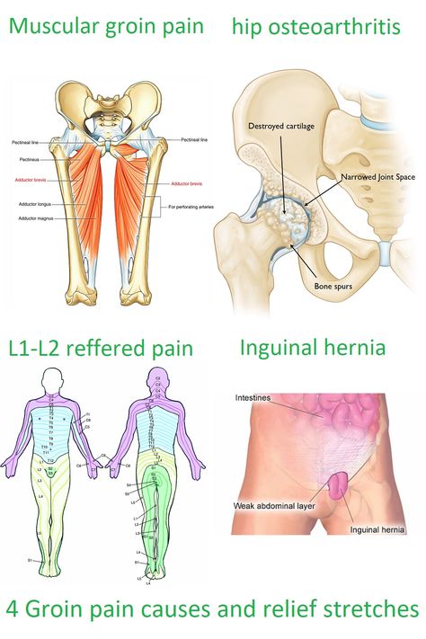 These are the 4 most common causes for groin pain. Groin pain caused by an inguinal hernia often needs surgery to recover, but the other causes for groin pain can be relieved with stretches and strength exercises for you lower back and hip. Check out our website for the treatment of groin pain. Muscles, Human