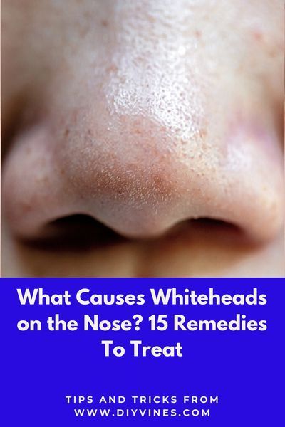 Whiteheads on nose are caused by oily skin, open skin pores and dirt. There are several whiteheads on nose removal remedies available. In this article I am sharing simple and easy home remedies to remove whiteheads on nose. #whiteheads #whiteheadsonnose #whiteheadsremovalremedies #howtoremovewhiteheads #beautytips #skincare Oily Nose Remedy, Strawberry Nose Remedy, How To Get Rid Of Strawberry Nose, Get Rid Of White Heads On Nose, Nose White Head Removal, How To Get Rid Of White Heads On Nose, How To Remove Whiteheads From Nose, White Heads Removal Remedies, Whiteheads Removal Remedies