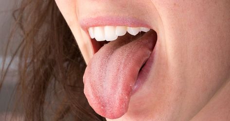 Burning mouth syndrome usually lacks an obvious cause and can affect various parts of the mouth or the whole mouth. It can make swallowing difficult. Mouth Problems, Detox Kur, Neck Surgery, Pimples Overnight, Candida Albicans, How To Get Rid Of Pimples, Dry Mouth, Serious Illness, Medical Terms