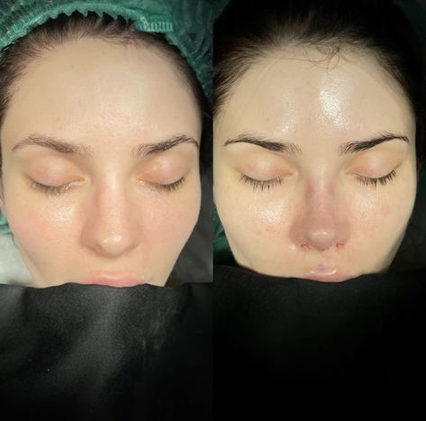 Turkey Nose Job Before And After, Round Face Nose Job, Big Nose Rhinoplasty, Button Nose Rhinoplasty, Bulbous Nose Job, Natural Nose Job Before After, Nose Job Inspiration Front View, Nose Job Inspo Front View, Rhinoplasty Front View