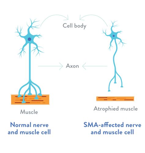 Biology Genetics, Basic Anatomy, Spinal Muscular Atrophy, Motor Neuron, Basic Anatomy And Physiology, Muscle Atrophy, Muscle Weakness, Diet Exercise, Spinal Cord