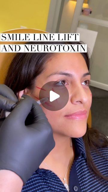 LIFTED BEAUTY, Filler, Threads, Botox on Instagram: "Smile line filler and Neurotoxin 💉✨ . Neurotoxin touch ups are needed every 3-4 months and filler touch ups are needed once a year 🙌🏼 . To book an appointment text or call our office at (562) 331-6543 Click the link in our bio to see our online schedule to book an appointment with one of Our Medical Providers 📲 . $45.00 Non Refundable Booking Fee Required To Book An Appointment 💰 . ⚠️Cancellation Policy ⚠️ $55 will be charged for no show/same day cancellations to the card on file . All products are FDA approved. Please visit the manufacturers website of the products that we use for all risk and side effects 🙌🏼 . All our treatments are customized to fit our patients anatomy and needs. Keep in mind that the number of units, syringes Botox For Smile Lines, Smile Line Fillers Before And After, Smile Line Filler, Marionette Lines Filler, Face Injections, Botox Before And After, Non Surgical Facelift, Marionette Lines, Thread Lift