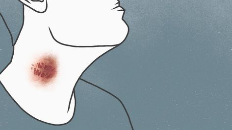 Get Rid Of A Hickey Fast, How To Hide A Hickey, Hickey Removal Quick, How To Get Rid Of A Hickey Fast, How To Get Rid Of Hickeys Quickly, Get Rid Of Hickies, Hickey Mark, Heart Of Hickeys, Neck Full Of Hickeys