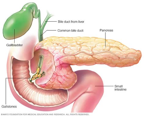 Pancreatitis - Symptoms and causes - Mayo Clinic Pancreatic Diet Recipes, Digestive System Disorders, Digestive Juice, Bile Duct, Types Of Cancers, Mayo Clinic, Chronic Inflammation, Medical Education, Digestive System