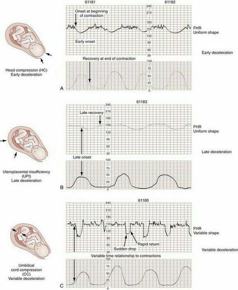 EFM and Decels Nursing Ob, Obstetrics Nursing, Fetal Heart Rate, Newborn Nursing, Midwifery Student, Child Nursing, Student Midwife, Labor Nurse, Nursing Mnemonics