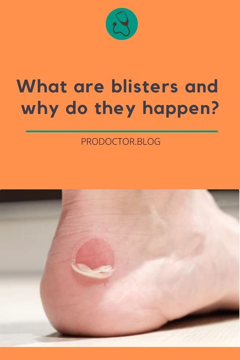 Chafing Remedies, Water Blister, How To Heal Blisters, Blood Blister, What Happens When You, The Skin, Our Body, The Way, Repair