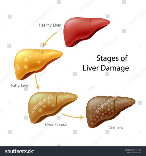 Stages of liver damage. Liver Disease. Healthy, fatty, liver fibrosis and Cirrhosis. Illustration isolated on white background. #Ad , #spon, #Liver#Disease#Healthy#Stages Liver Damage, Liver Diet, Liver Failure, Stem Cell Therapy, Cell Therapy, Healthy Liver, Scar Tissue, Liver Health, Skin Care Remedies