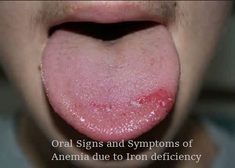 Anemia due to Iron Deficiency which i has many Oral signs and symptoms ... Iron Deficiency Remedies, Burning Mouth, Burning Tongue, Remedies For Dry Mouth, Tongue Health, Dry Mouth, Integrative Health, Natural Herbs, Natural Home Remedies