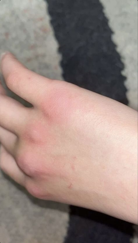 Burned Hand Pic, Fake Injury, Medicine Snaps, Hospital Admit Hand Pics, Hands Photos, Hand Pictures, Profile Pictures Instagram, Best Poses For Pictures, Insta Profile Pic