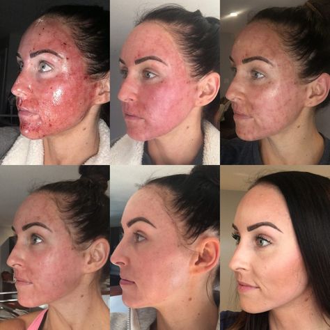 My Experience w/ Profractional & Why I Keep Going Back | Profractional Laser, Prp Hair, Laser Skin Resurfacing, Beauty Procedures, Laser Resurfacing, Severe Acne, Smile Makeover, Skin Resurfacing, Laser Therapy