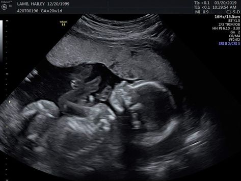 22 Week Ultrasound, Baby Girl Ultrasound, 15 Week Ultrasound, 3d Ultrasound Pictures, Ultrasound Student, 20 Week Ultrasound, Twins Ultrasound, Baby Ultrasound Pictures, 2 Months Pregnant