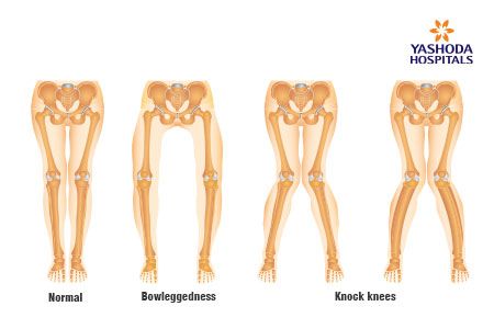 Osteogenesis Imperfecta Tattoo, Hyoid Bone Anatomy, Biology Flashcards, Osteoid Osteoma, Temporal Bone Anatomy, Osteogenesis Imperfecta, Genetic Disorders, Medical School Studying, Medical Assistant