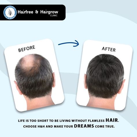 Hair Transplant, Confidence, Hair, Design