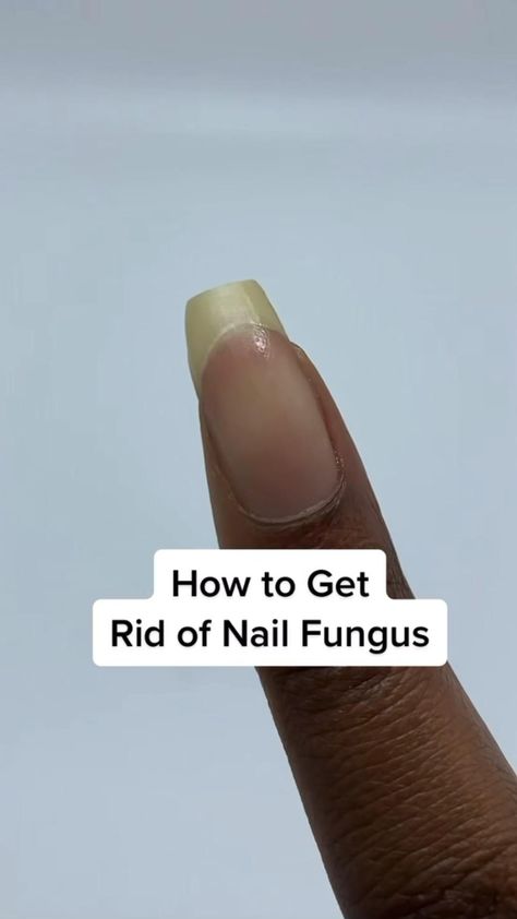 Fungal Nail Nails Grow Faster, Toenail Health, Nail Growth Tips, Grow Nails Faster, Homemade Body Care, Toenail Fungus Remedies, Fast Nail, Nail Fungus Remedy, Natural Nail Care