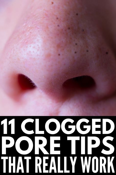 Clogged Pores On Nose, Get Rid Of Clogged Pores, Big Pores, Nose Pores, Blackheads On Nose, Face Pores, Clear Pores, Get Rid Of Blackheads, Skin Remedies