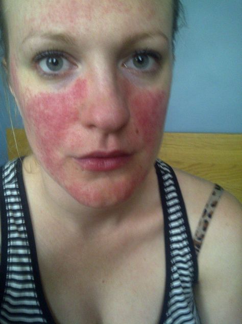 What is rosacea? Many people with rosacea don't know they have this skin condition so I have written about common symptoms and triggers. Read it here! Skin Care Home Remedies, Anti Aging Eye Cream, Anti Aging Face Cream, Natural Anti Aging, Skin Condition, Clear Complexion, Natural Moisturizer, Natural Face, Anti Aging Skin Products