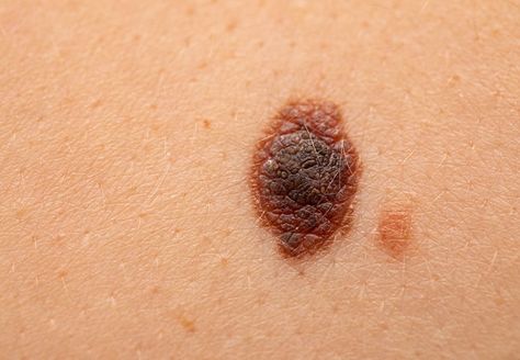 Learn how to spot the warning signs of a potentially cancerous mole. Cancerous Moles, Moles On Face, Red Moles, Skin Moles, Blemish Remover, Cleveland Clinic, Warning Signs, Health And Wellbeing, Mole