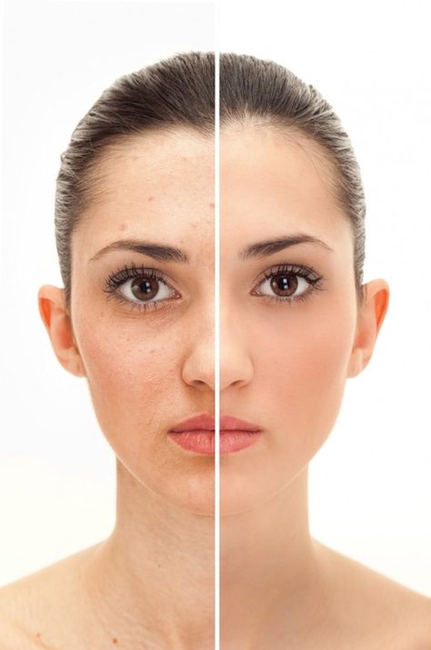 Embarrassing dark spots on your face can be a part of the aging process, or caused by acne or small bite scars. Black Spots On Face, Ipl Photofacial, Facial Warts, Warts On Face, Brown Spots On Skin, Natural Acne Remedies, Brown Spots Removal, Brown Spots On Face, How To Get Rid Of Pimples