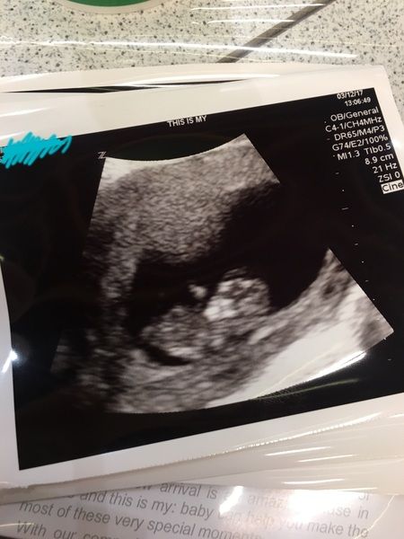 10 Week Ultrasound Pictures, 10 Weeks Pregnant Ultrasound, 15 Week Ultrasound, 10 Week Ultrasound, 8 Week Ultrasound, 12 Week Scan, Pregnancy Scan, Wonder Family, 10 Weeks Pregnant