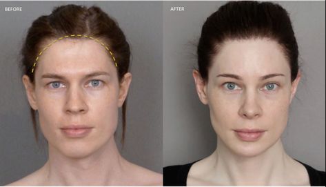 Hairline feminization: seeking perfection in feminizing the forehead region | Facialteam Forehead Reduction Surgery, Jaw Reduction Surgery, Forehead Reduction, Lipo Before And After, Plastic Surgery Fail, Face Surgery, Plastic Surgery Gone Wrong, Cheek Fillers, Nose Surgery