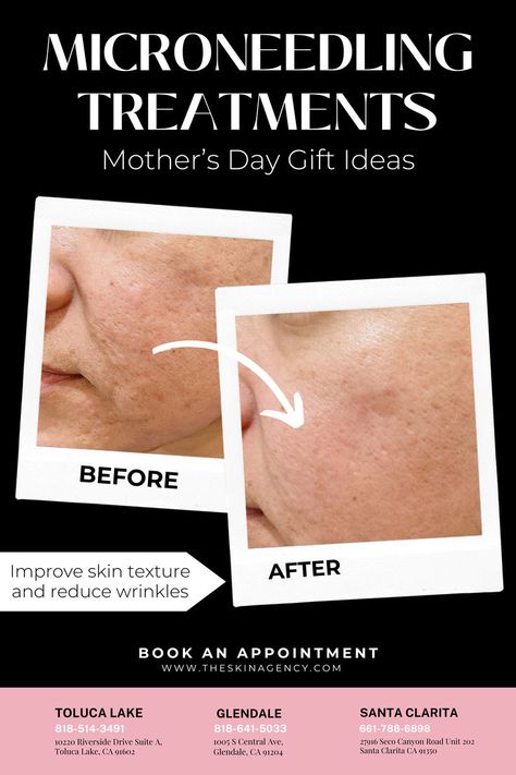 Looking for a unique Mother's Day gift idea? Consider microneedling to help her achieve smooth skin, reduce wrinkles, and improve skin texture. A perfect addition to any anti aging skin care and facial care regimen. Schedule a gift session today! #MicroneedlingLosAngeles #LosAngelesSkinCare #LosAngelesMedSpa #FacialCareLosAngeles Enhance Beauty, Erase Wrinkles, Facial Rejuvenation, Unique Mothers Day Gifts, Anti Aging Skin, Dermal Fillers, Improve Skin Texture, Sun Exposure, Facial Features