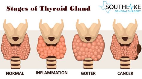 Thyroid Surgery Recovery, Swollen Thyroid, Total Thyroidectomy, What Is Thyroid, Thyroid Surgery, Thyroid Remedies, Eye Problems, Graves Disease, Agent Orange