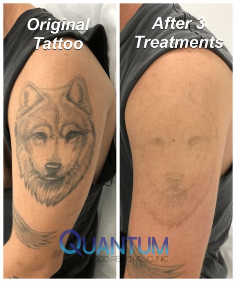 My clinic also offers interest free.. Web want to know more about tattoo removal cost brisbane?. Web as a result, it produces very precise light on a specific wavelength that can be focused to approx.. Small tattoo removal from $150* buy 2.You can look new details of Tattoo Removal Price Brisbane by click this link : view details Picosure Tattoo Removal, Brisbane Tattoo, Tattoo Removal Cost, Be Focused, Cosmetic Procedures, Tattoo Removal, About Tattoo, Small Tattoo, New Details