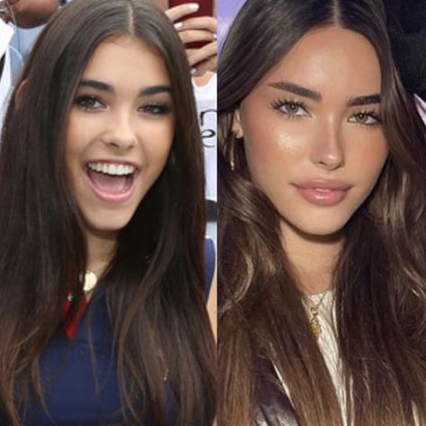 Madison beer plastic surgery Madison Beer Lips Before And After, Madison Beer Before And After Surgery, Madison Beer Plastic Surgery, Maria Core, Madison Beer Outfits, Celebrities Before And After, Lip Filler, Glo Up, After Surgery