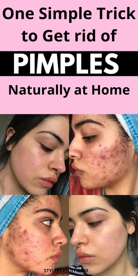 How to Get Rid of Pimples: 9 Remedies for Pimples on face - StylePersuit Remedies For Pimples On Face, How To Treat Pimples, Red Skin Spots, Remedies For Pimples, Pimple Solution, Home Remedies For Pimples, Get Rid Of Pimples, Blind Pimple, Rid Of Pimples