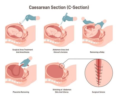 C Section Recovery, C Section, Baby Birth