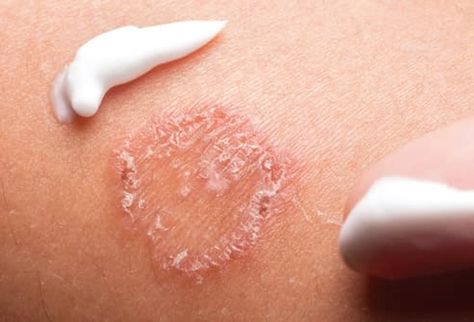 What You Should Know About Skin Infections Seborrheic Keratosis, Skin Parasites, Skin Moles, Squamous Cell, Skin Bumps, Bacterial Infection, Cold Sore, Layers Of Skin, Skin Problems