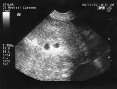 i am 5 weeks 2 days along in our first ultrasound pix! i am goin back this thurs to see if dr sees 2nd yolk sac in the bigger embryo! wish me luck! 2 Weeks Pregnant Ultrasound, Usg Pregnancy Photography, Usg Pregnancy, 5 Week Ultrasound Pictures, Twins Ultrasound, Baby Ultrasound Pictures, Baby In Womb, Ultra Sound, Medical Ultrasound