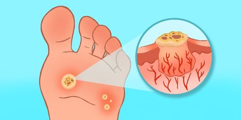 Plantar warts are painful growths on the bottom of your feet that can stick around for years if left untreated. Plantar Wart Removal, Planters Wart, Plantar Warts, Home Remedies For Warts, Warts Remedy, Get Rid Of Warts, Laser Therapy, Reproductive Health, Tea Tree Oil