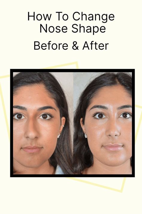 How to Fix a Crooked Nose, change nose shape, crooked nose, straighten nose bridge, straighten nose, perfect nose shape Perfect Nose Shape, Nose Straightener, Crooked Face, Crooked Nose, Nose Reshaping, Natural Mouthwash, Face Proportions, Yoga Information, Nose Makeup